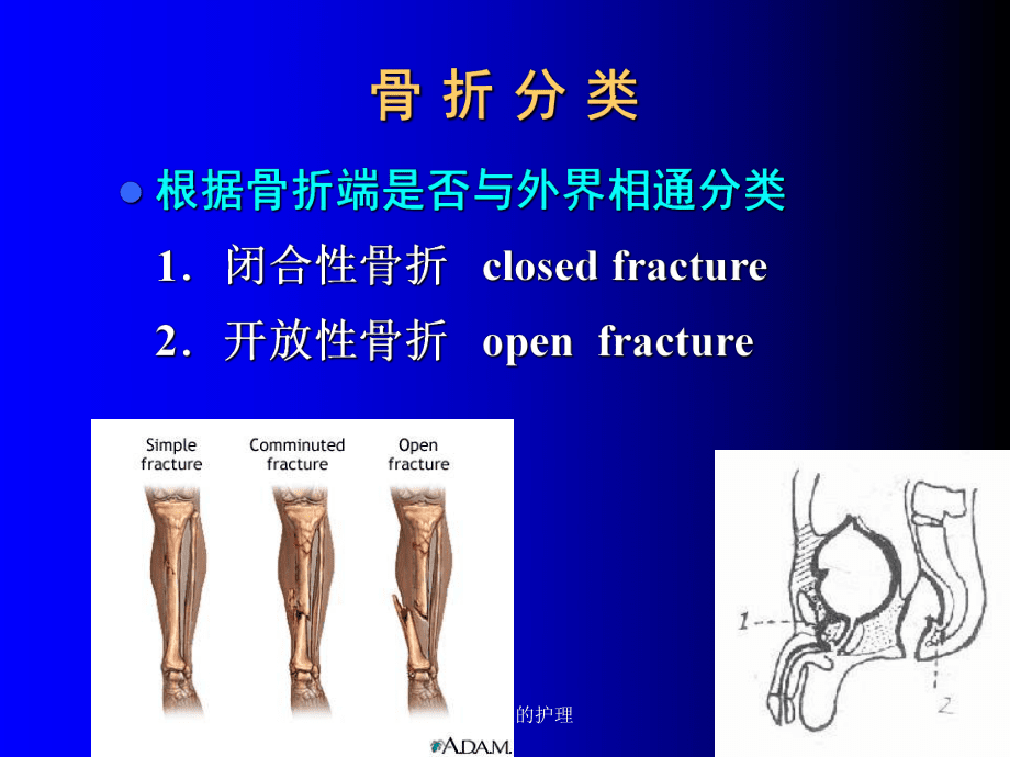 骨折病人的护理_第4页