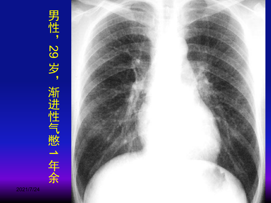 彌漫性肺疾病的影像學(xué)診斷思路PPT課件_第4頁(yè)