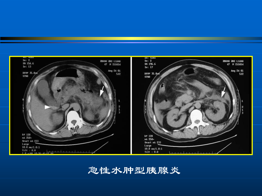 胰腺影像诊断word版本_第4页