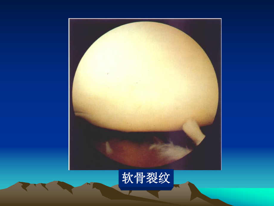 膝关节镜检查过程_第4页