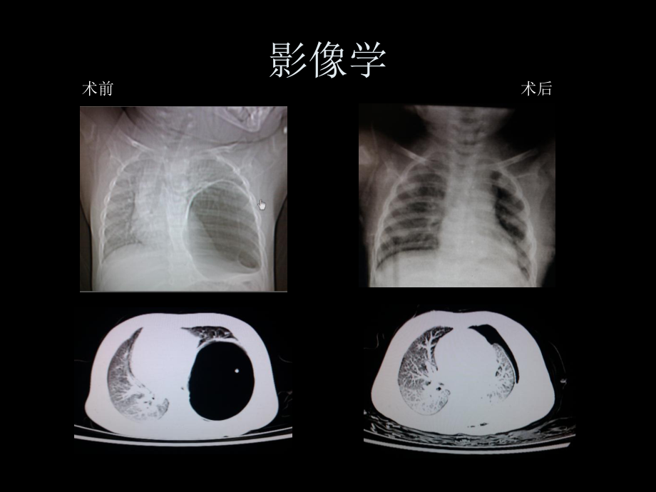 馬爾尼菲青霉菌病_第5頁