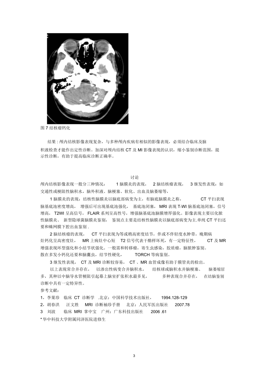 脑结核CT诊断及MRI诊断精编版_第3页