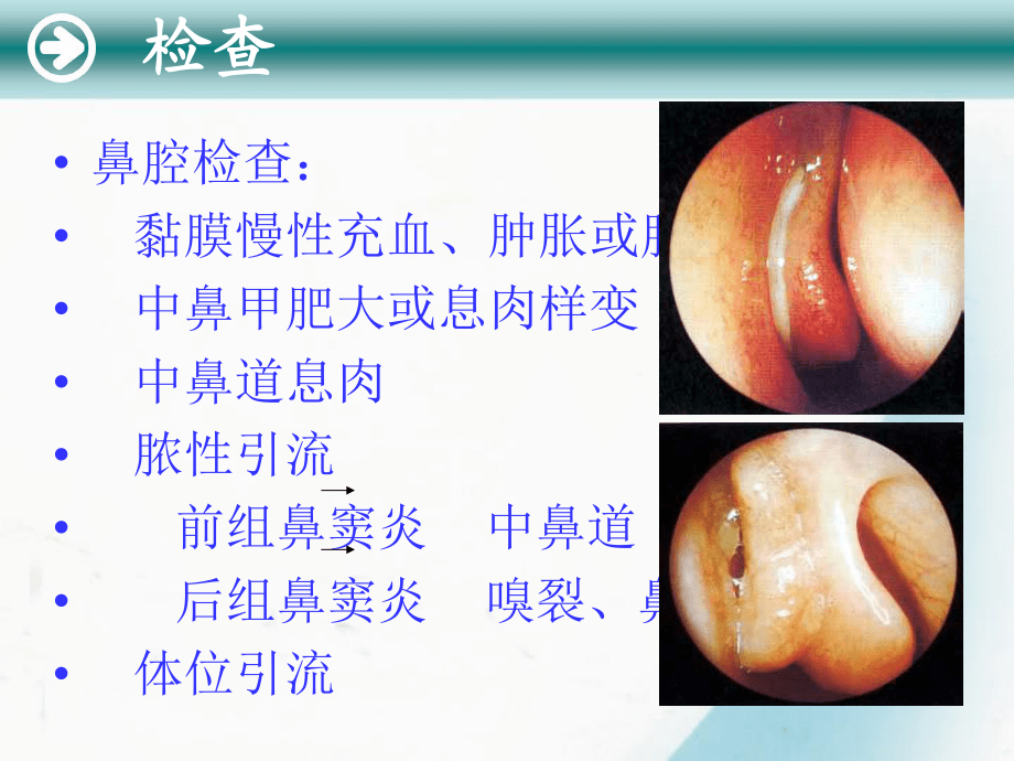 慢性鼻竇炎-ppt課件_第5頁