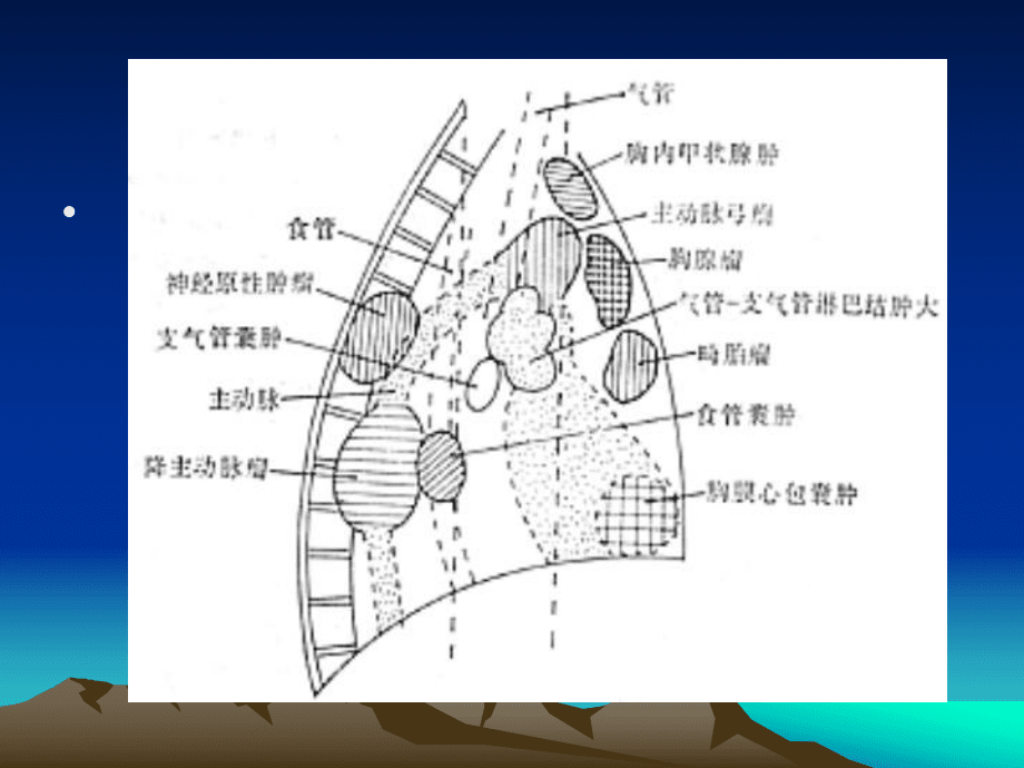 纵膈肿瘤影像诊断报告_第4页