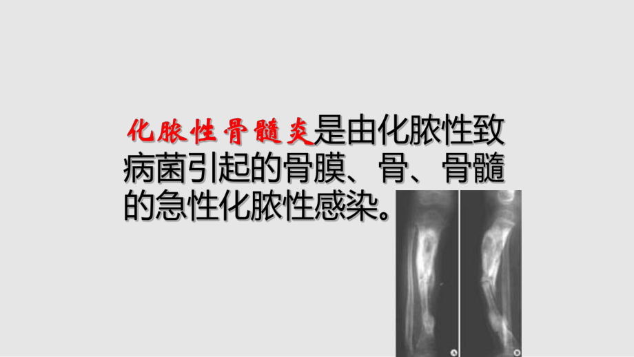 化脓性骨髓炎病人护理_第3页