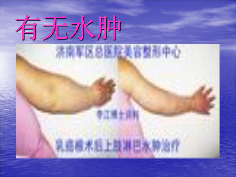 乳腺癌水肿的护理ppt课件.ppt_第5页