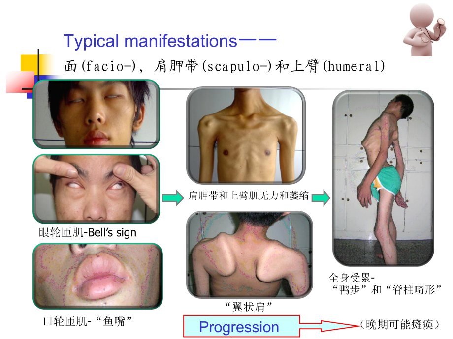 面肩肱型肌营养不良症的临床表现与分子遗传学特征分析_第4页