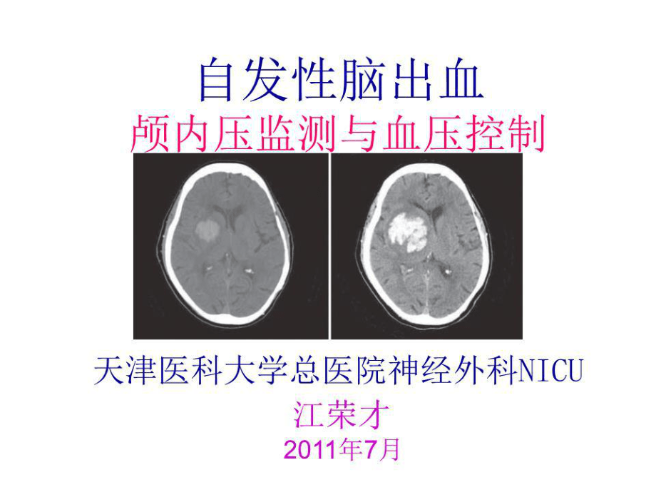 《高血壓腦出血》PPT課件.ppt_第1頁(yè)