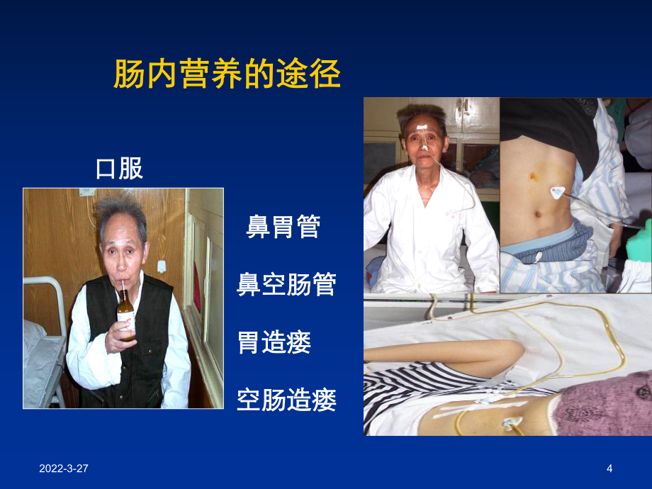 肠内营养的护理_第4页