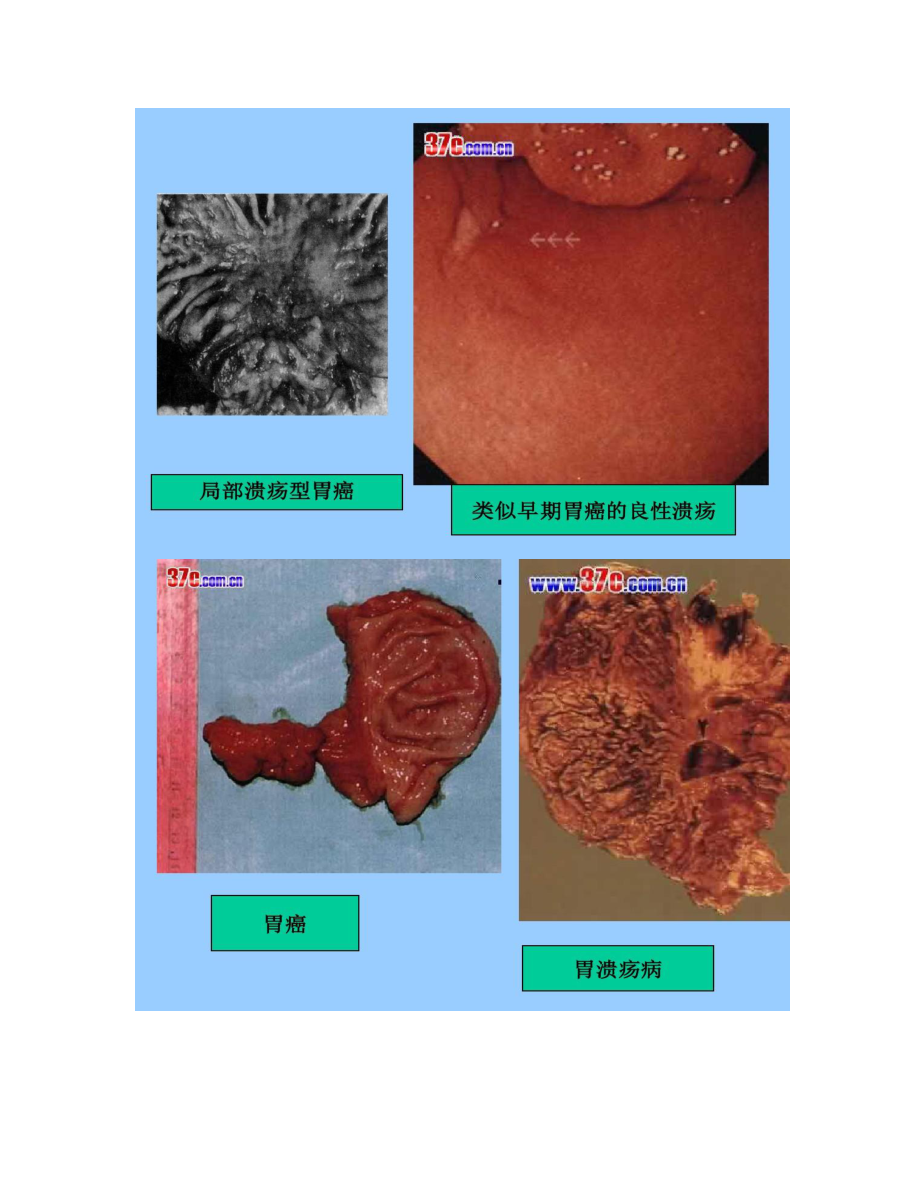 熊锋宝教授讲授消化系统的疾病与健康_第4页