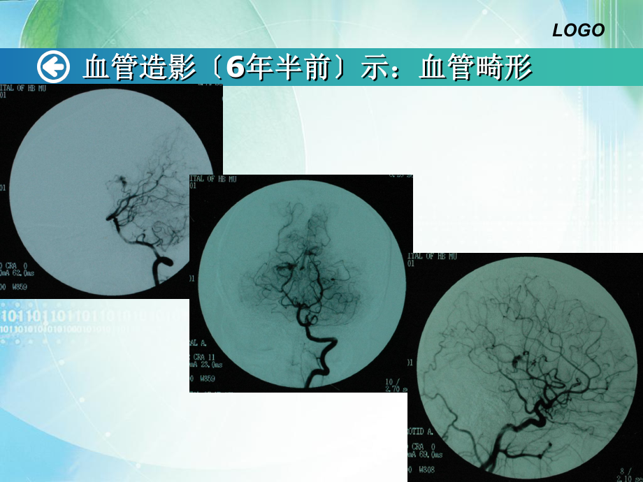 丘脑病变2例分析 (2)ppt课件_第3页