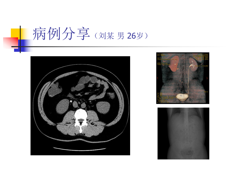 泌尿排石合劑在輸_第4頁
