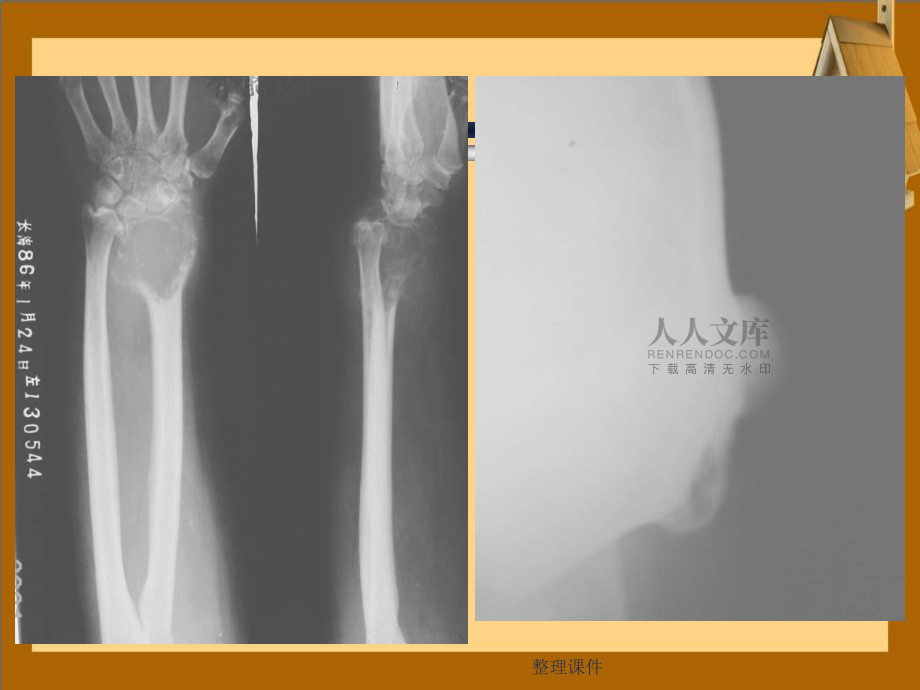 《骨肿瘤x线表现》_第2页