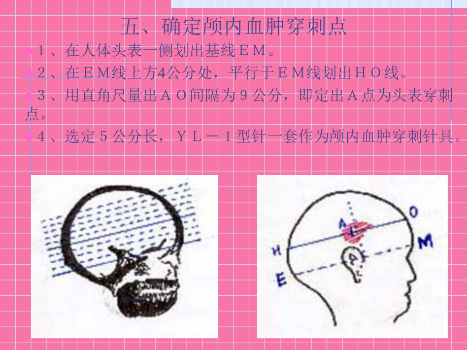 顱內血腫CT片定位ppt課件_第5頁