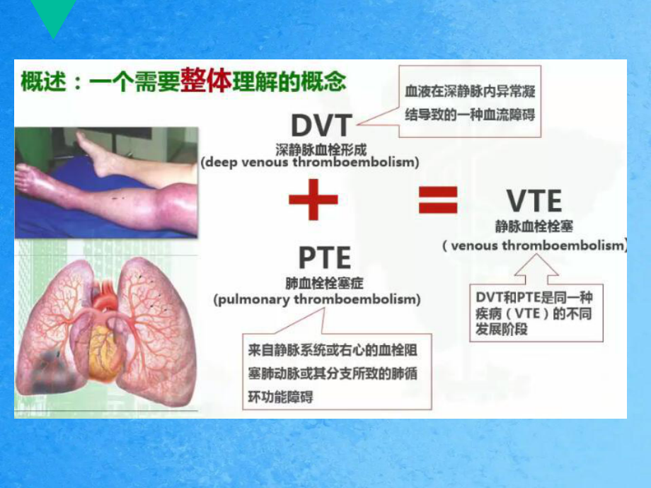 護士與DVT的預防ppt課件_第4頁