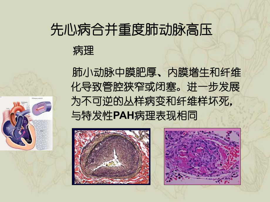 先心病并重度肺动脉高压治疗单中心经验_第2页