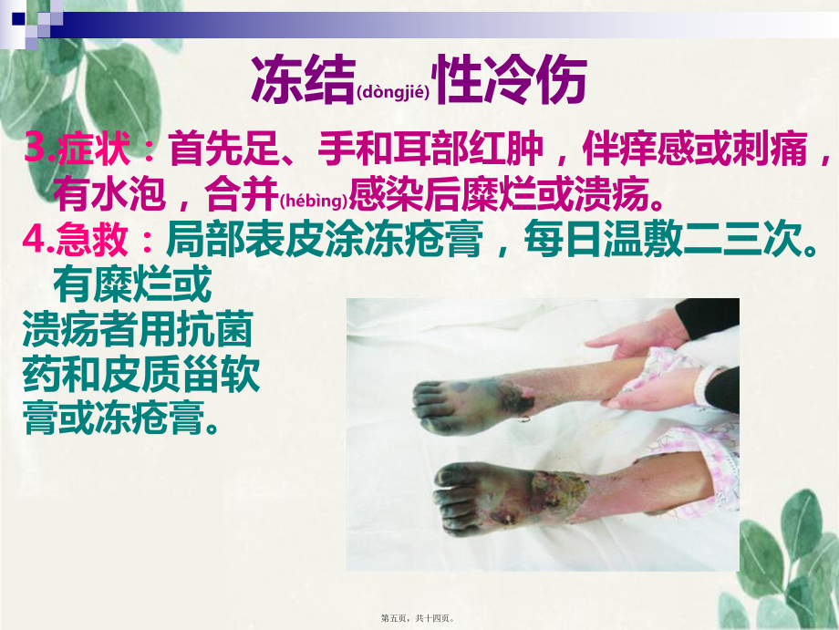 2022年凍傷的急救_第5頁(yè)