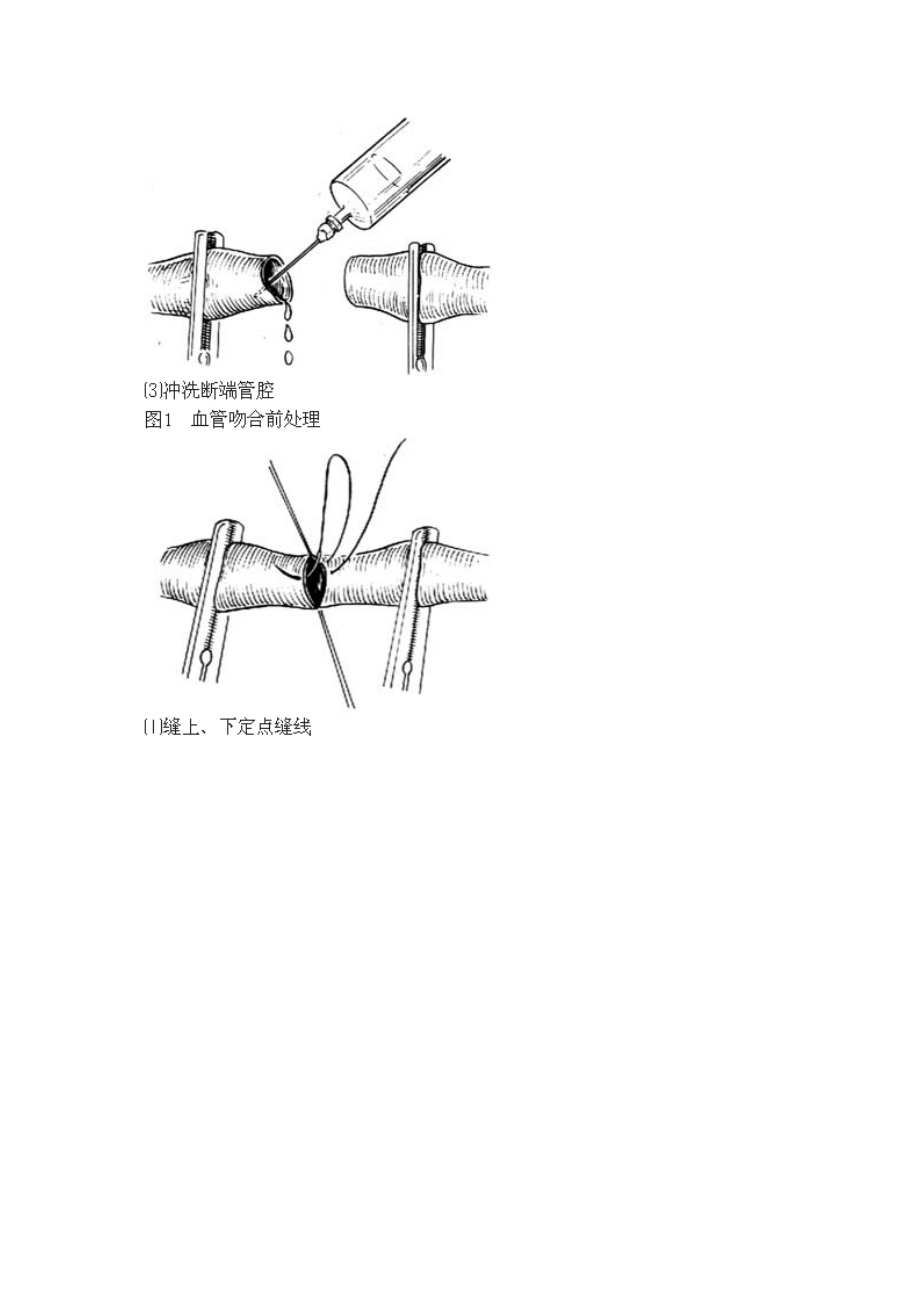 6月9日血管端端吻合術(shù)_第4頁(yè)