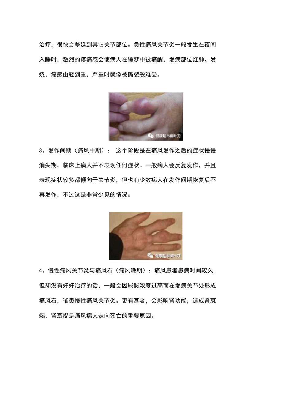 痛風(fēng)患者與高尿酸血癥的膳食指導(dǎo)_第3頁