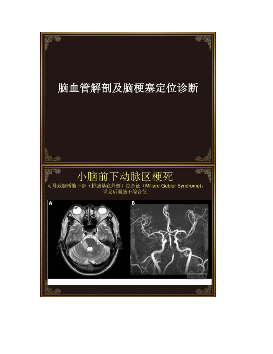 【图文】脑血管解剖及脑梗塞定位诊断-迷路动脉_第1页