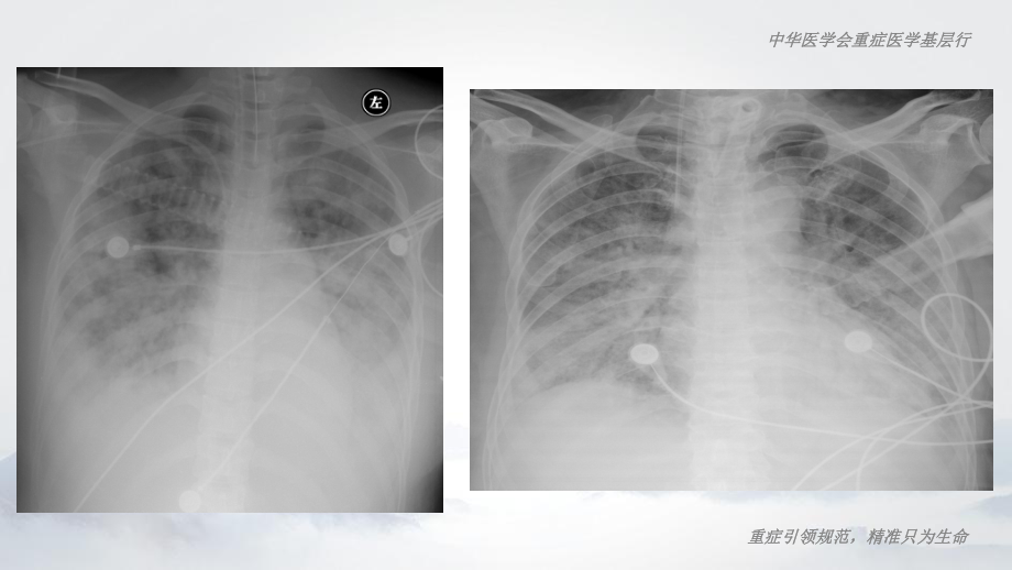 俯卧位通气:理论与实践_第5页