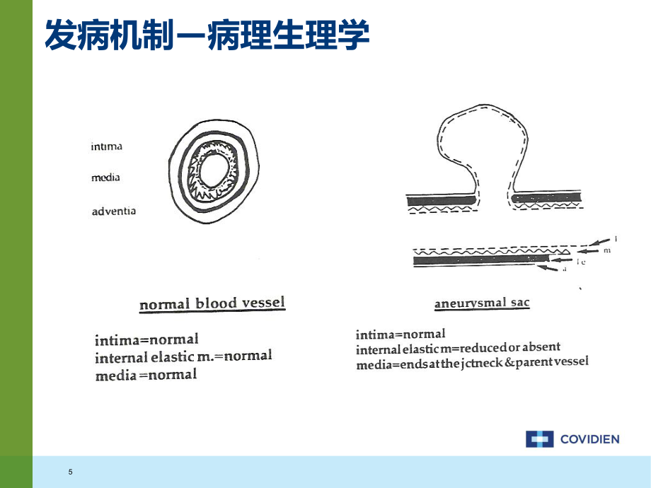 动脉瘤疾病知识及诊断治疗_第5页