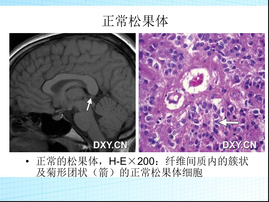 松果体区病变影像诊断_第5页
