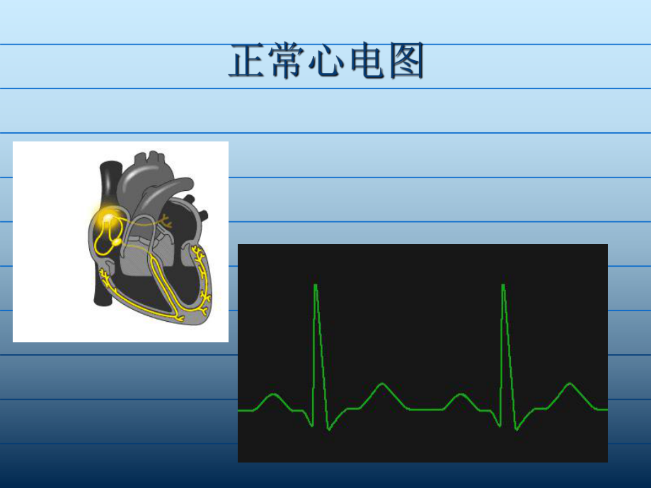 心電監(jiān)護常見心律失常的識別及處理-醫(yī)學(xué)課件_第3頁