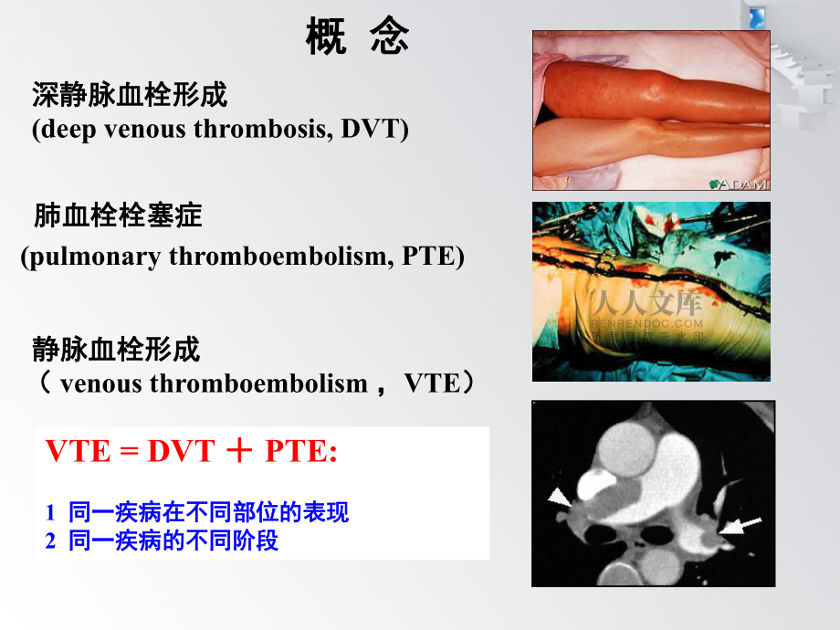 肺血栓栓塞症【课件】_第2页